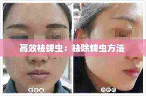 高效祛蜱虫:祛除蜱虫方法