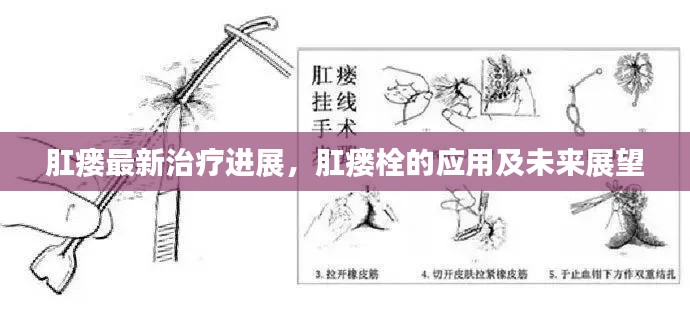 肛瘘最新治疗进展，肛瘘栓的应用及未来展望